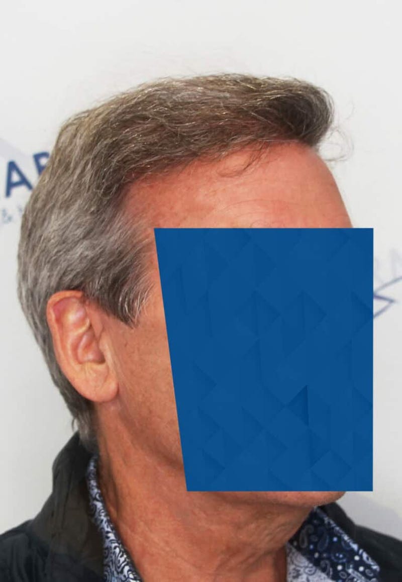 Results Before & After Gallery - Patient 339158 - Image 2