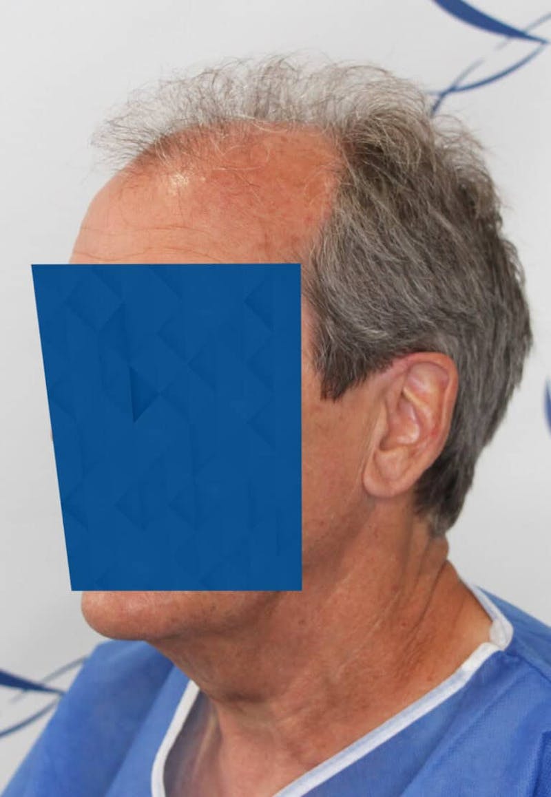 Results Before & After Gallery - Patient 339158 - Image 3