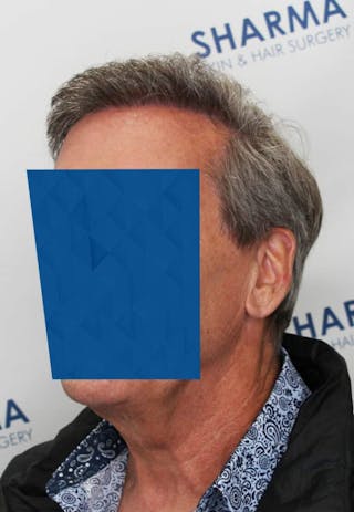 Results Before & After Gallery - Patient 339158 - Image 4