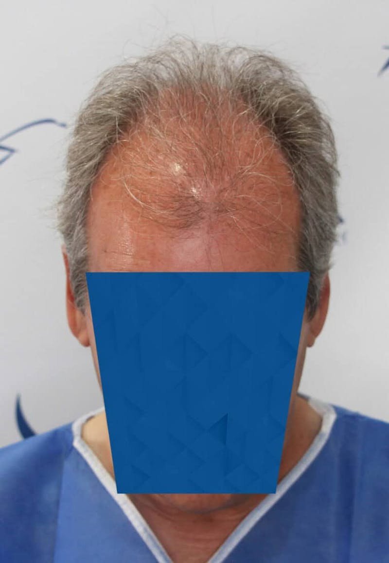 Results Before & After Gallery - Patient 339158 - Image 5