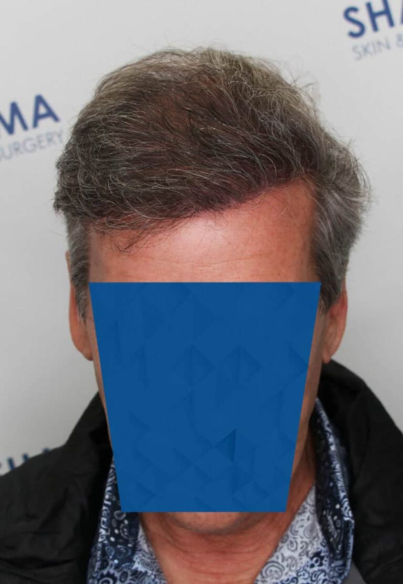 Results Before & After Gallery - Patient 339158 - Image 6