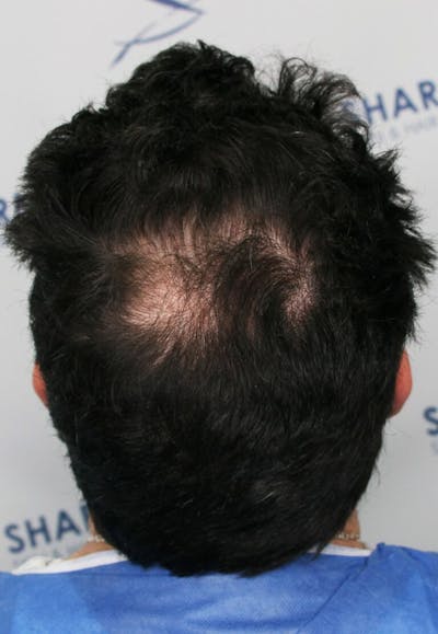 Results Before & After Gallery - Patient 146556 - Image 1