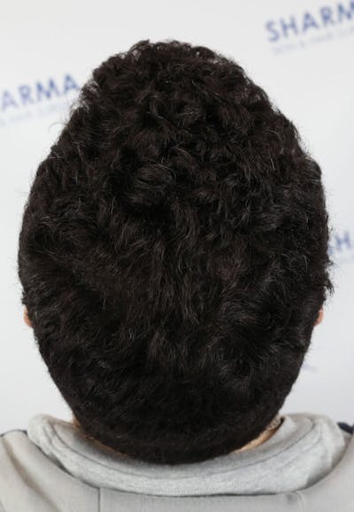 Results Before & After Gallery - Patient 146556 - Image 2