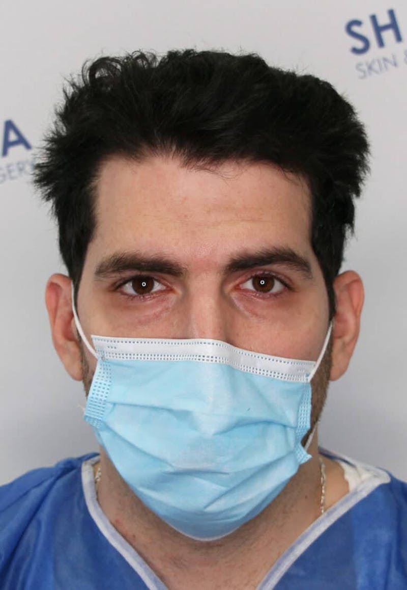 Results Before & After Gallery - Patient 146556 - Image 3