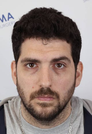 Results Before & After Gallery - Patient 146556 - Image 4