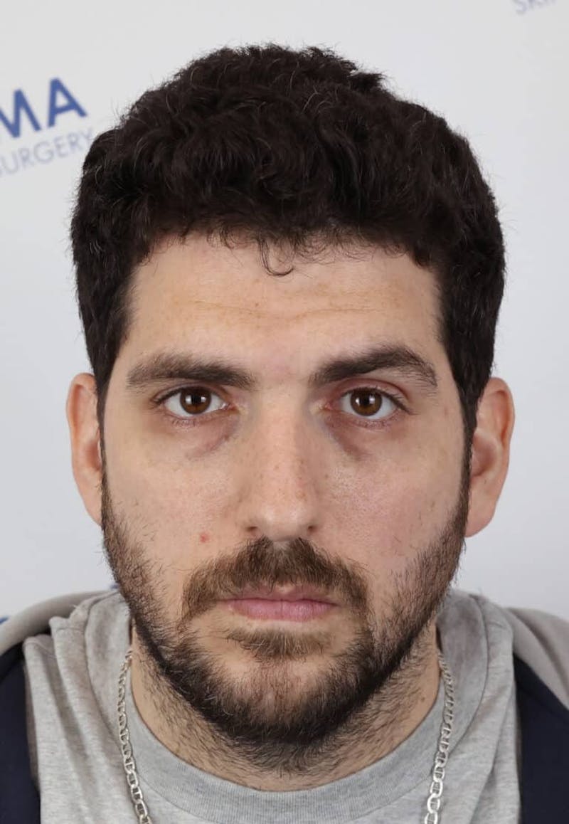 Results Before & After Gallery - Patient 146556 - Image 4