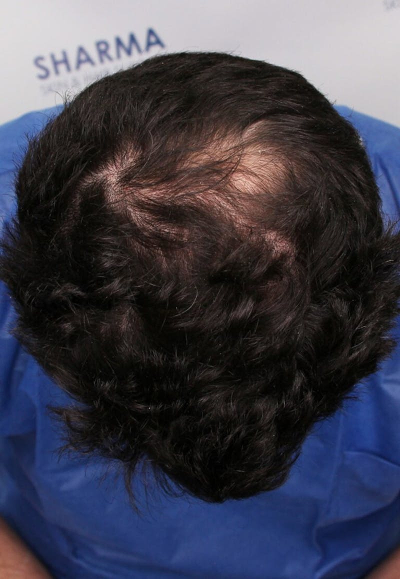 Results Before & After Gallery - Patient 146556 - Image 5