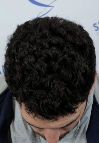Results Before & After Gallery - Patient 146556 - Image 6