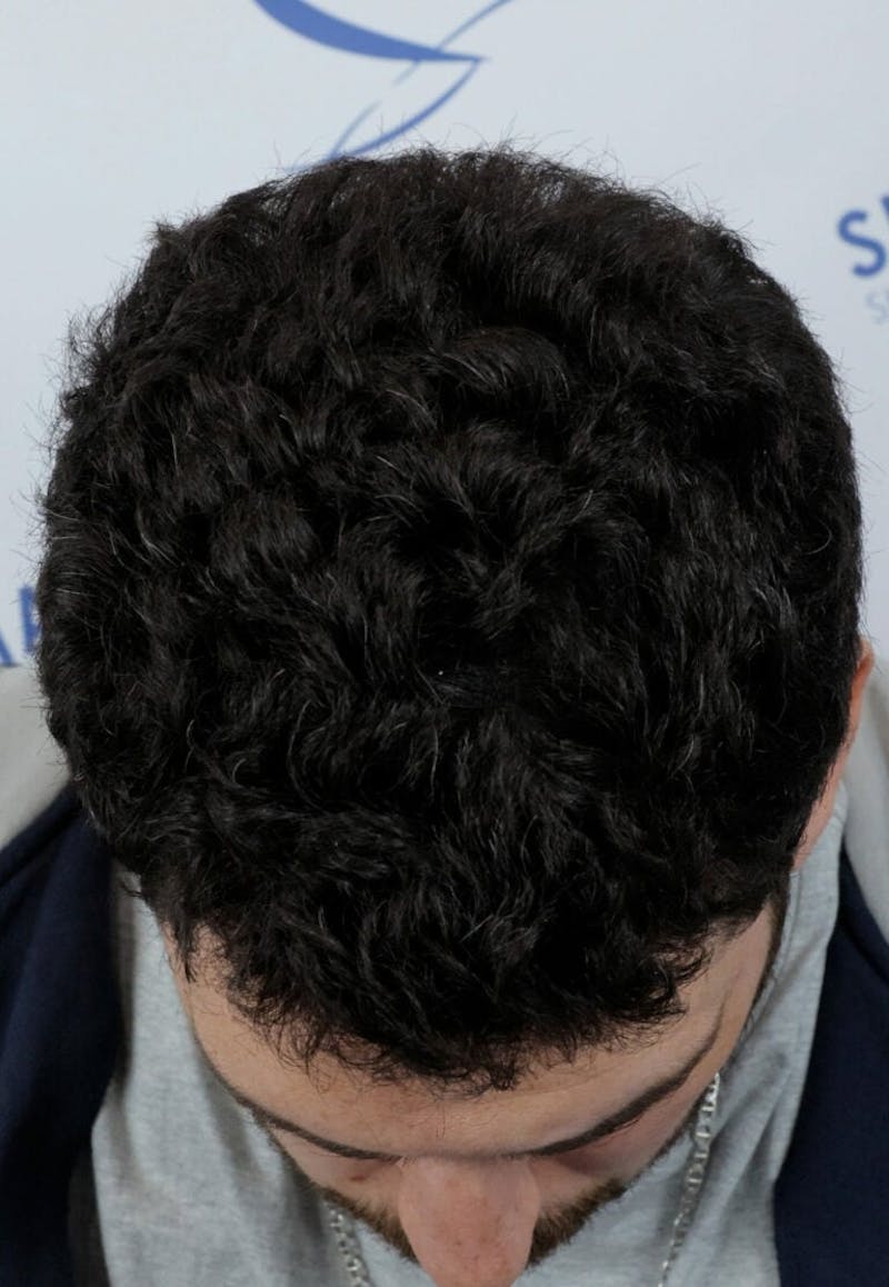 Results Before & After Gallery - Patient 146556 - Image 6