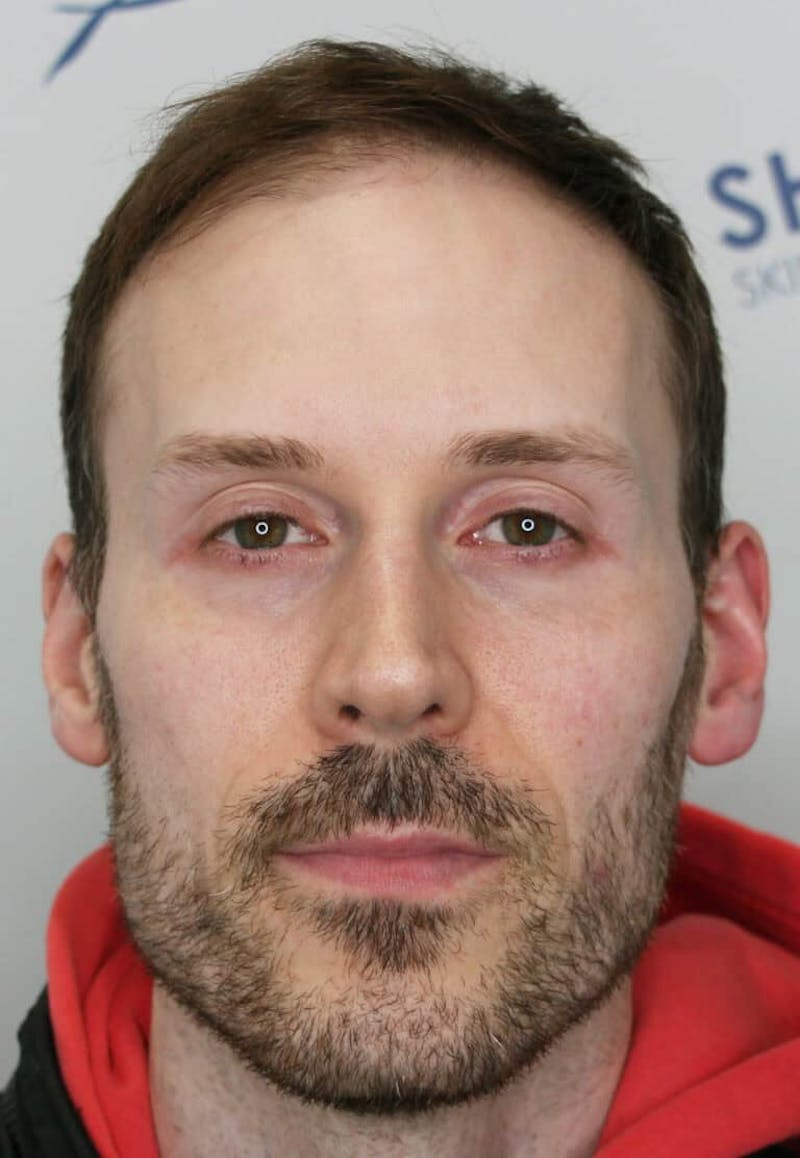 Results Before & After Gallery - Patient 319986 - Image 1