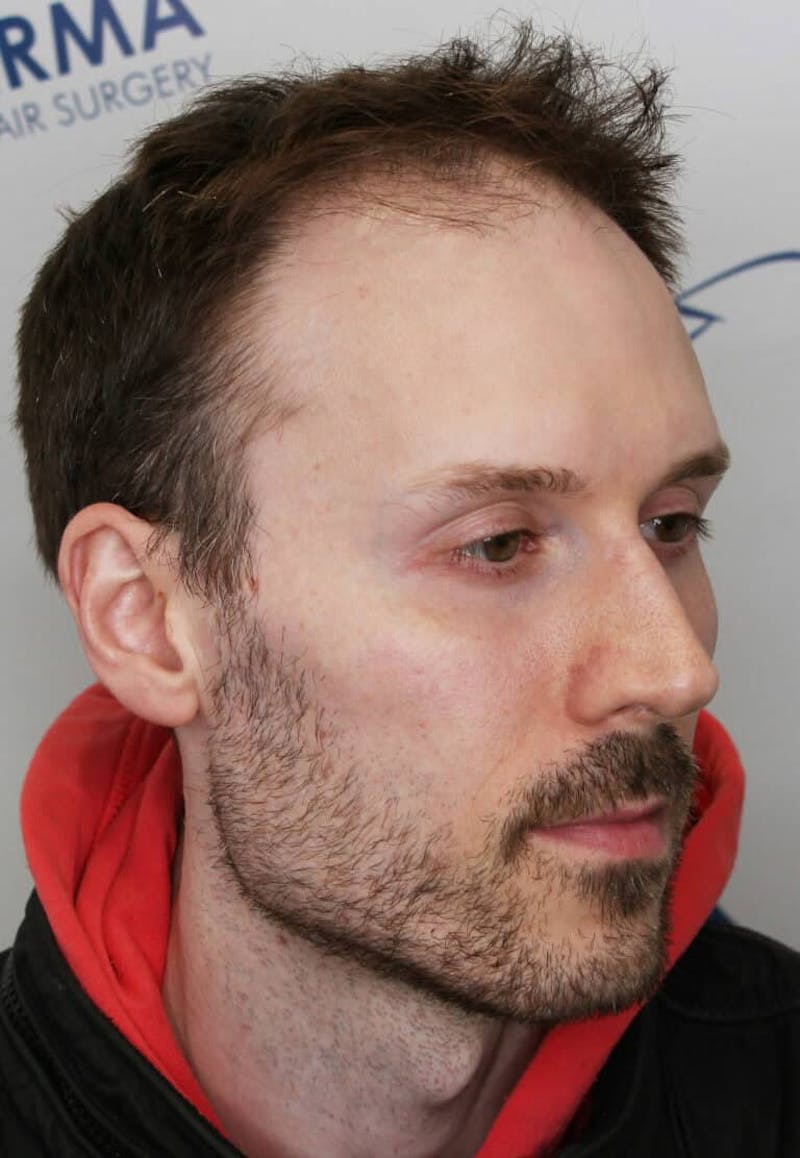 Results Before & After Gallery - Patient 319986 - Image 3