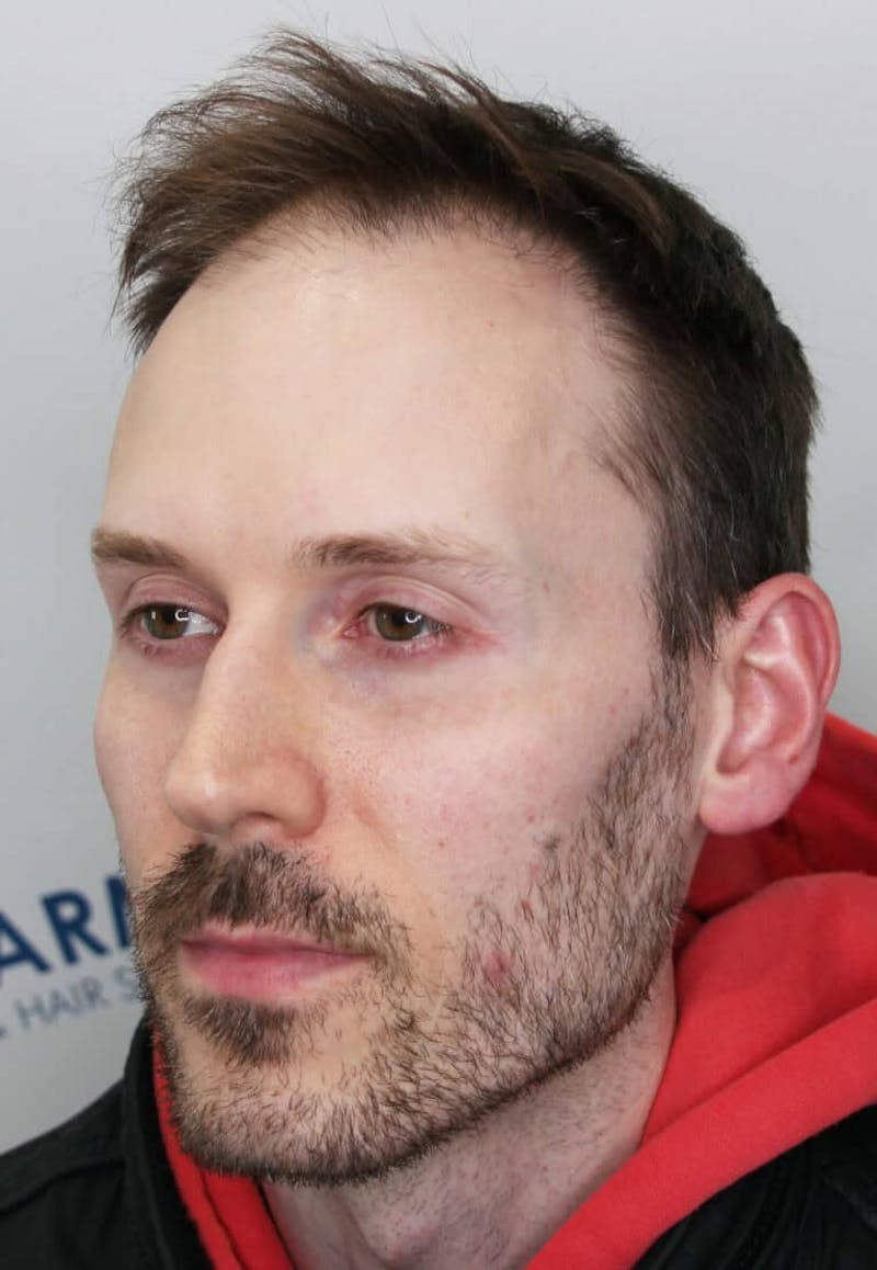 Results Before & After Gallery - Patient 319986 - Image 5