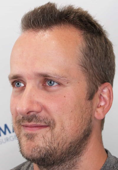 Results Before & After Gallery - Patient 413845 - Image 1