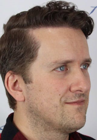 Results Before & After Gallery - Patient 413845 - Image 4