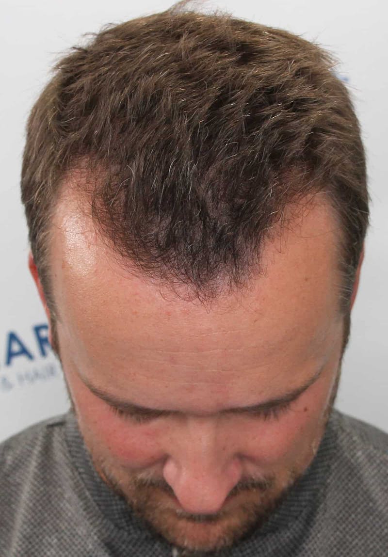 Results Before & After Gallery - Patient 413845 - Image 5