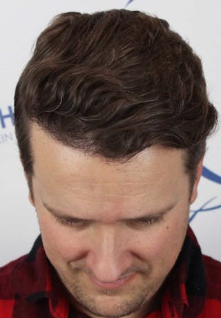 Results Before & After Gallery - Patient 413845 - Image 6