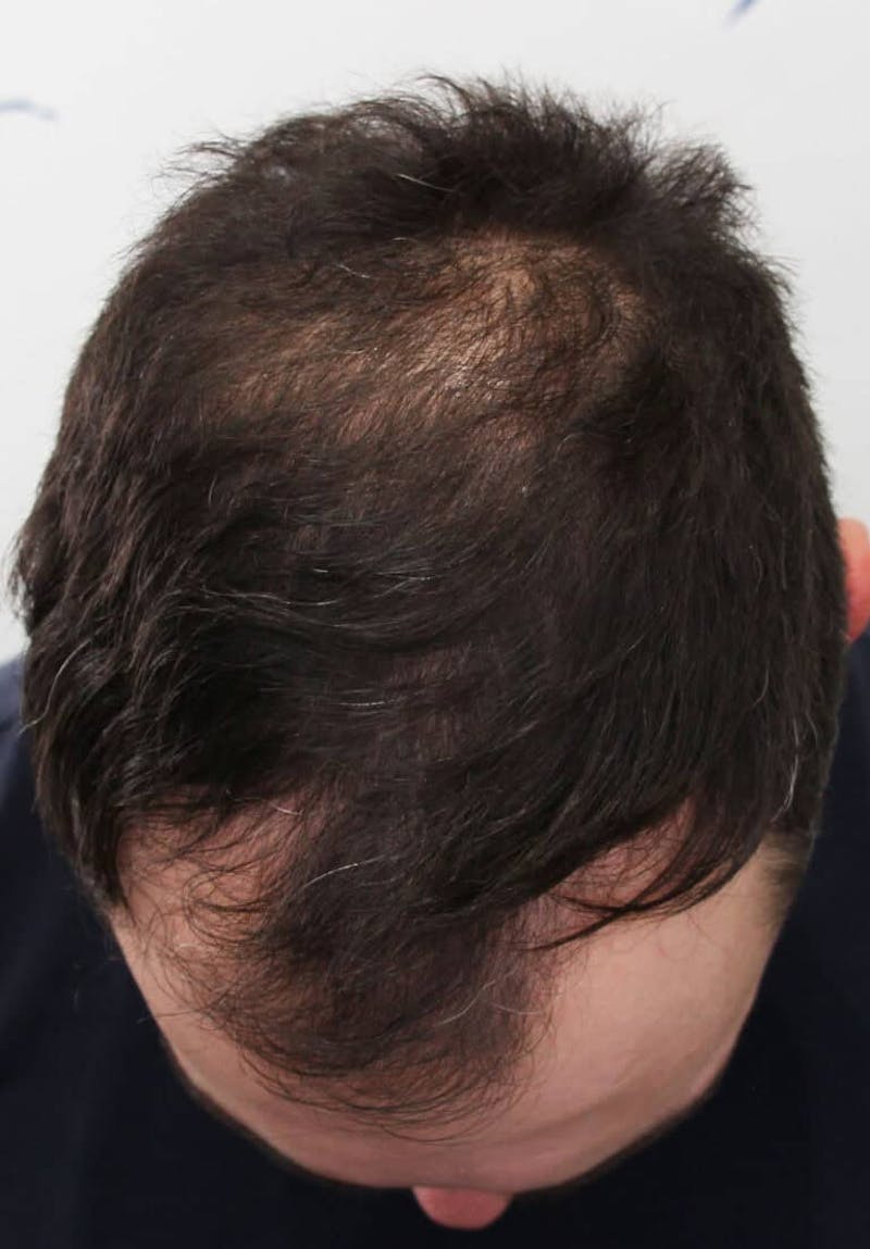 Results Before & After Gallery - Patient 177197 - Image 1