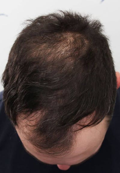 Results Before & After Gallery - Patient 177197 - Image 1