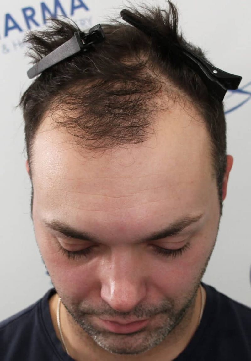 Results Before & After Gallery - Patient 177197 - Image 3