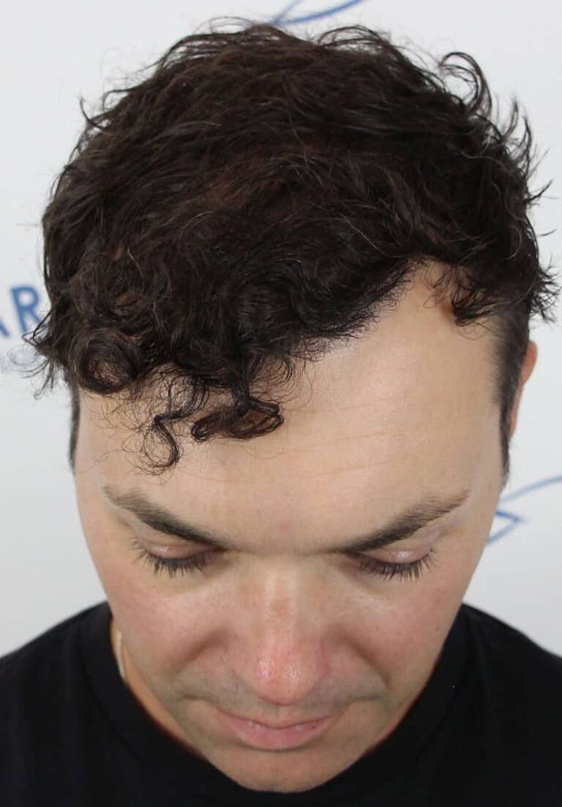 Results Before & After Gallery - Patient 177197 - Image 4