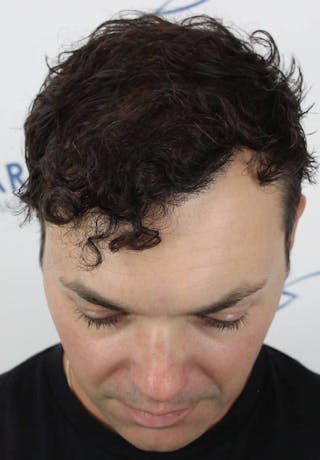Results Before & After Gallery - Patient 177197 - Image 4