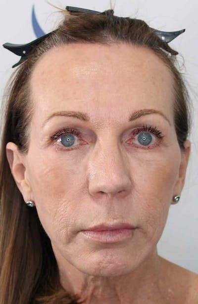 Results Before & After Gallery - Patient 312680 - Image 1
