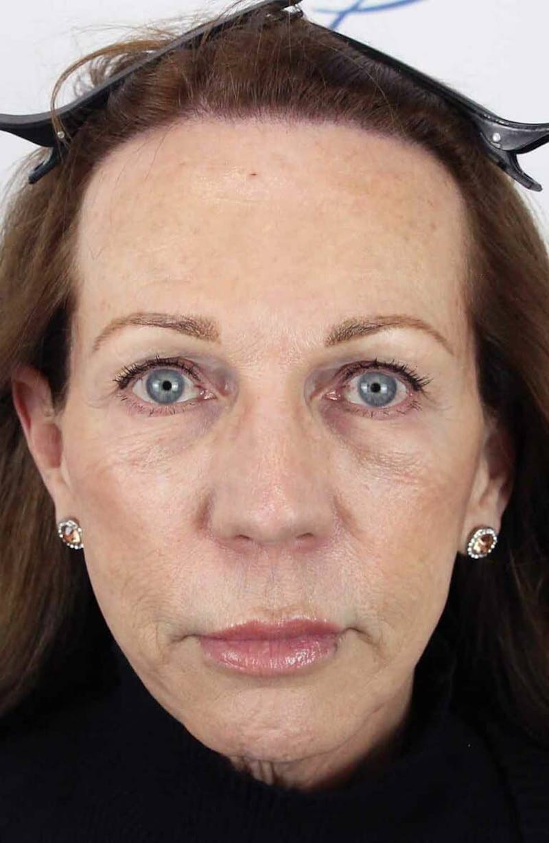 Results Before & After Gallery - Patient 312680 - Image 2