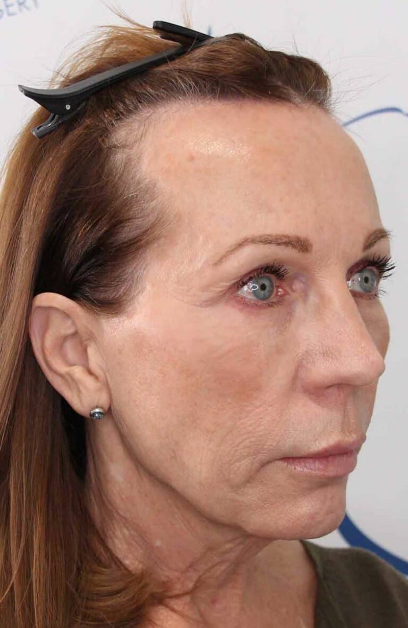 Results Before & After Gallery - Patient 312680 - Image 3
