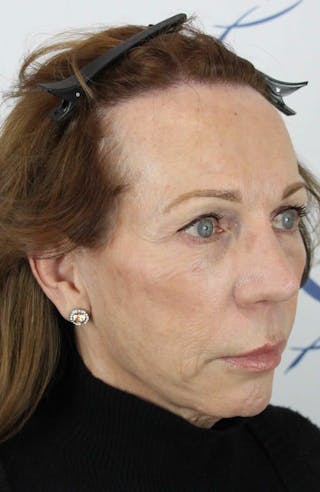 Results Before & After Gallery - Patient 312680 - Image 4