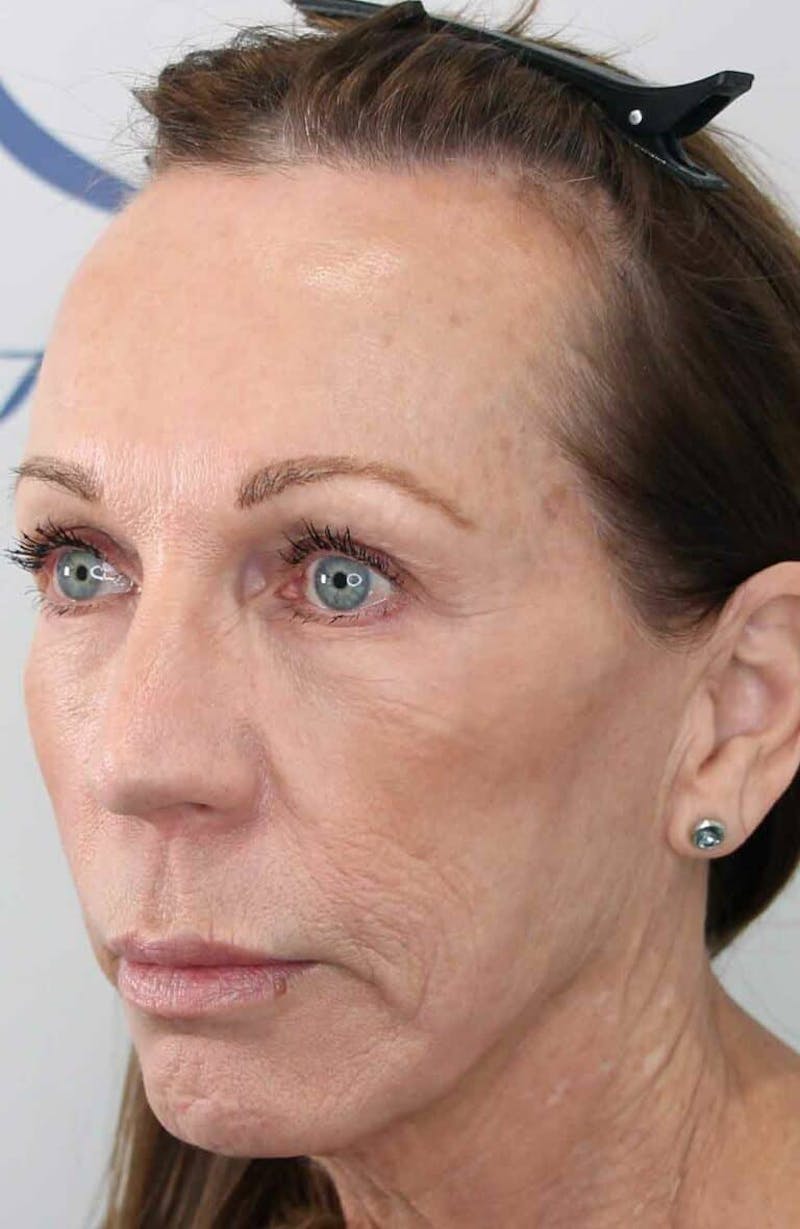 Results Before & After Gallery - Patient 312680 - Image 5