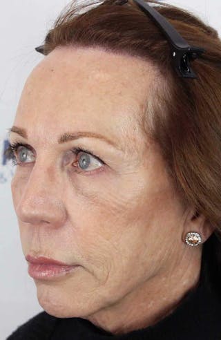 Results Before & After Gallery - Patient 312680 - Image 6