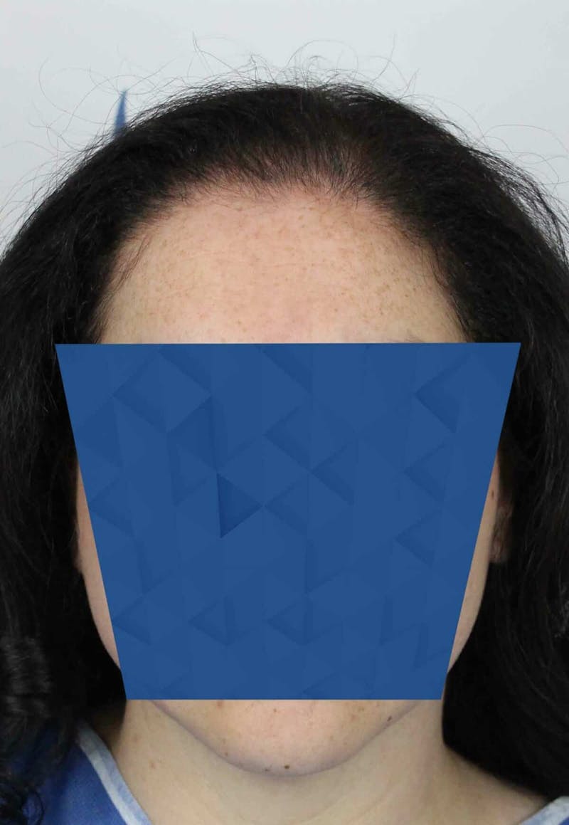 Results Before & After Gallery - Patient 336658 - Image 1