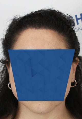 Results Before & After Gallery - Patient 336658 - Image 2