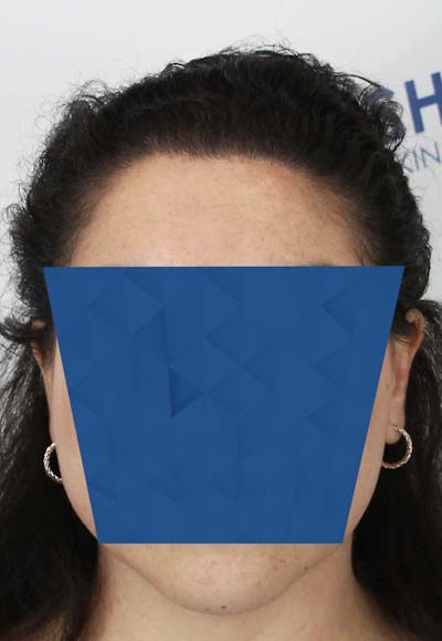 Results Before & After Gallery - Patient 336658 - Image 2