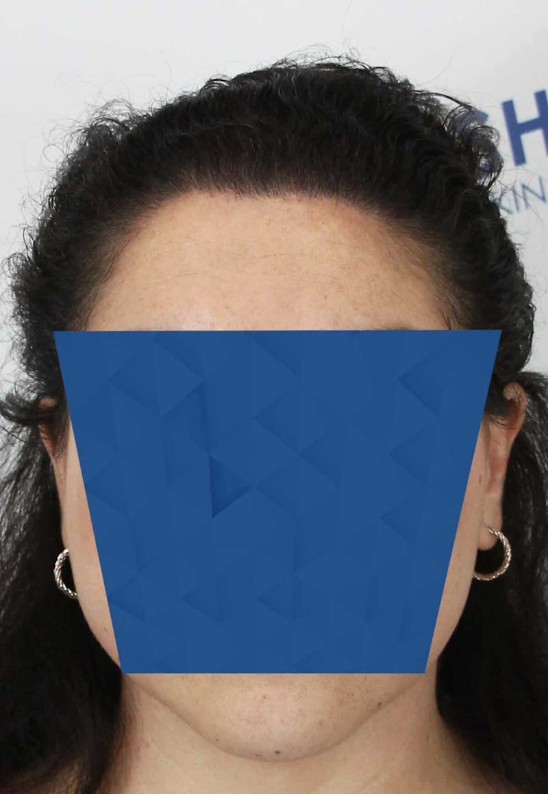 Results Before & After Gallery - Patient 336658 - Image 2