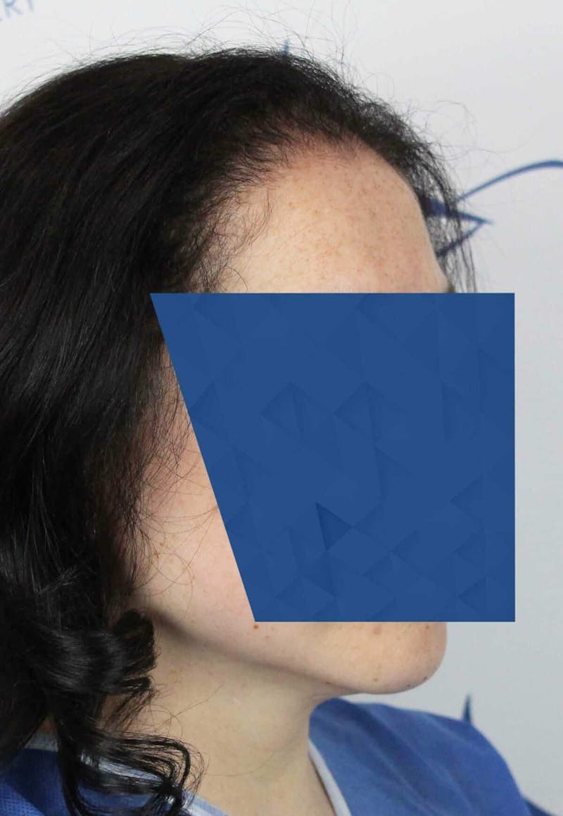 Results Before & After Gallery - Patient 336658 - Image 3