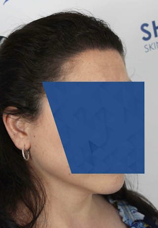 Results Before & After Gallery - Patient 336658 - Image 4
