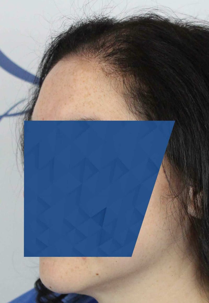 Results Before & After Gallery - Patient 336658 - Image 5