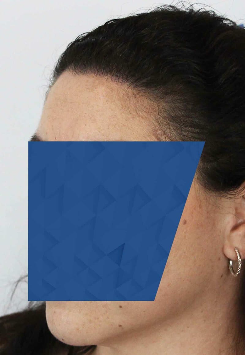 Results Before & After Gallery - Patient 336658 - Image 6