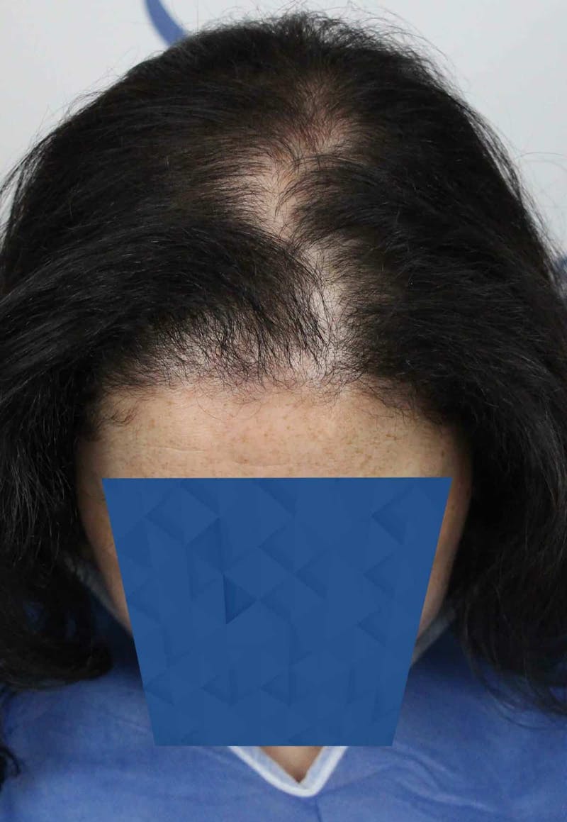 Results Before & After Gallery - Patient 336658 - Image 7