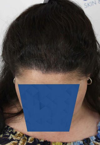 Results Before & After Gallery - Patient 336658 - Image 8
