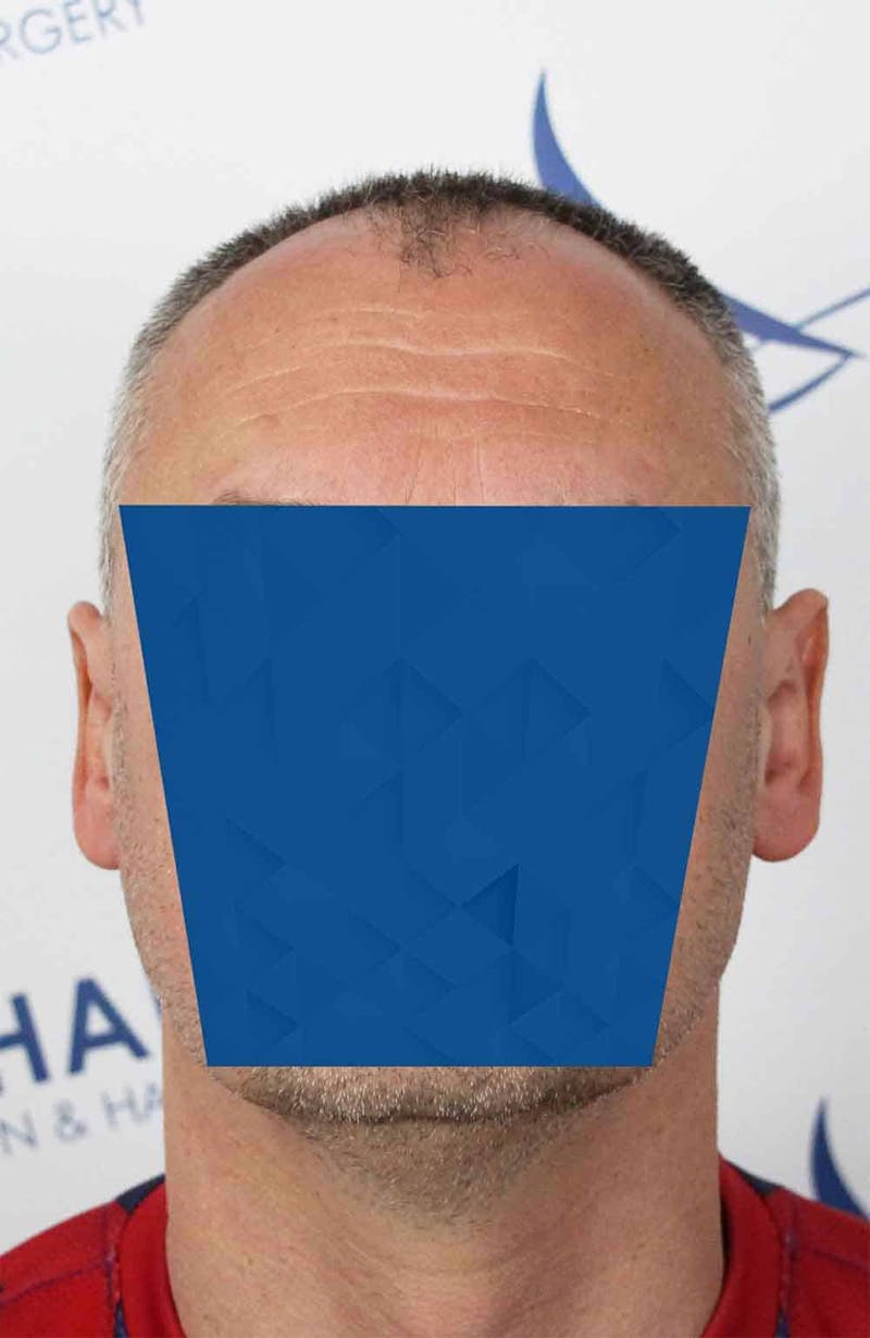 Results Before & After Gallery - Patient 366847 - Image 1