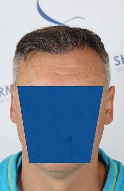 Results Before & After Gallery - Patient 366847 - Image 2