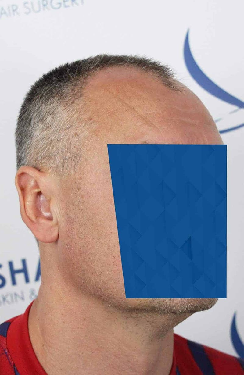 Results Before & After Gallery - Patient 366847 - Image 3