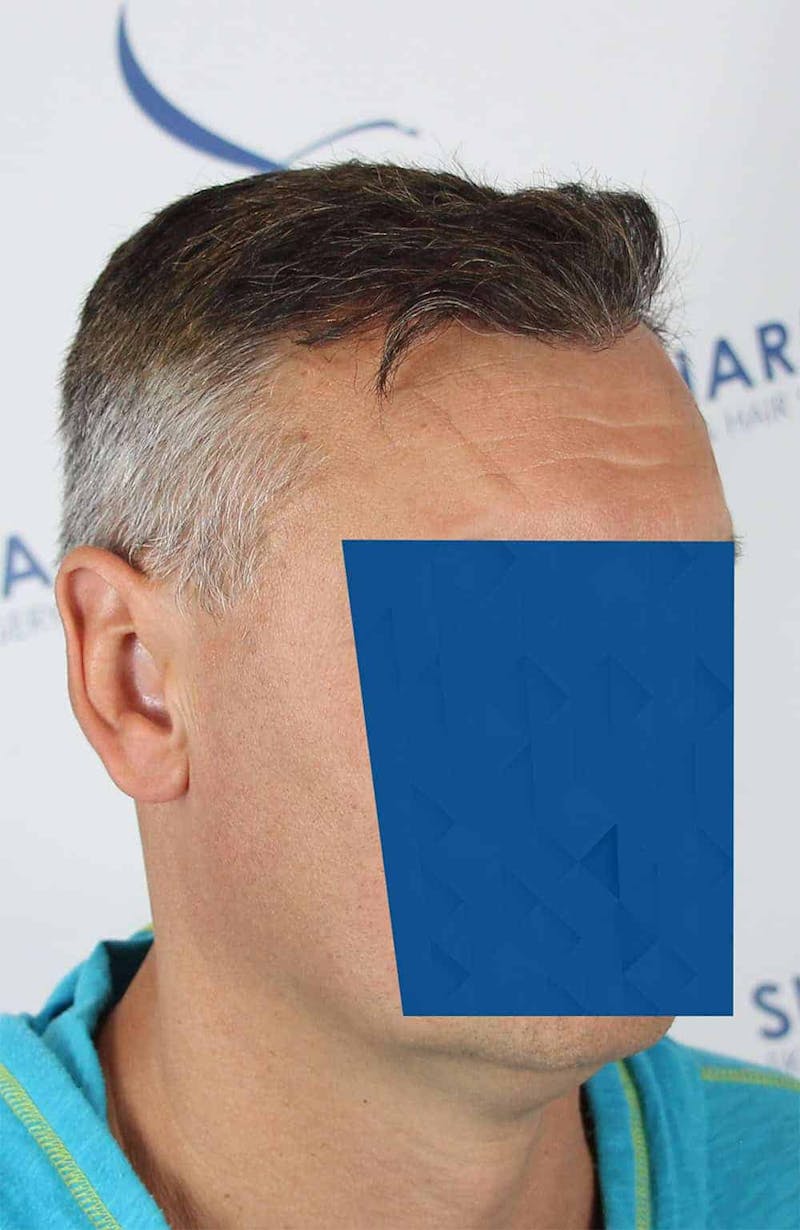Results Before & After Gallery - Patient 366847 - Image 4
