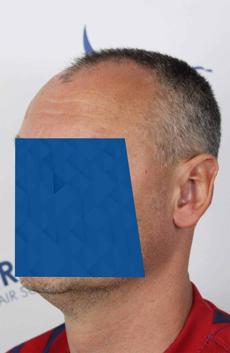 Results Before & After Gallery - Patient 366847 - Image 5