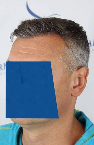 Results Before & After Gallery - Patient 366847 - Image 6