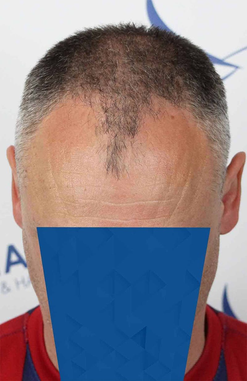 Results Before & After Gallery - Patient 366847 - Image 7