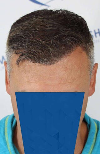 Results Before & After Gallery - Patient 366847 - Image 8