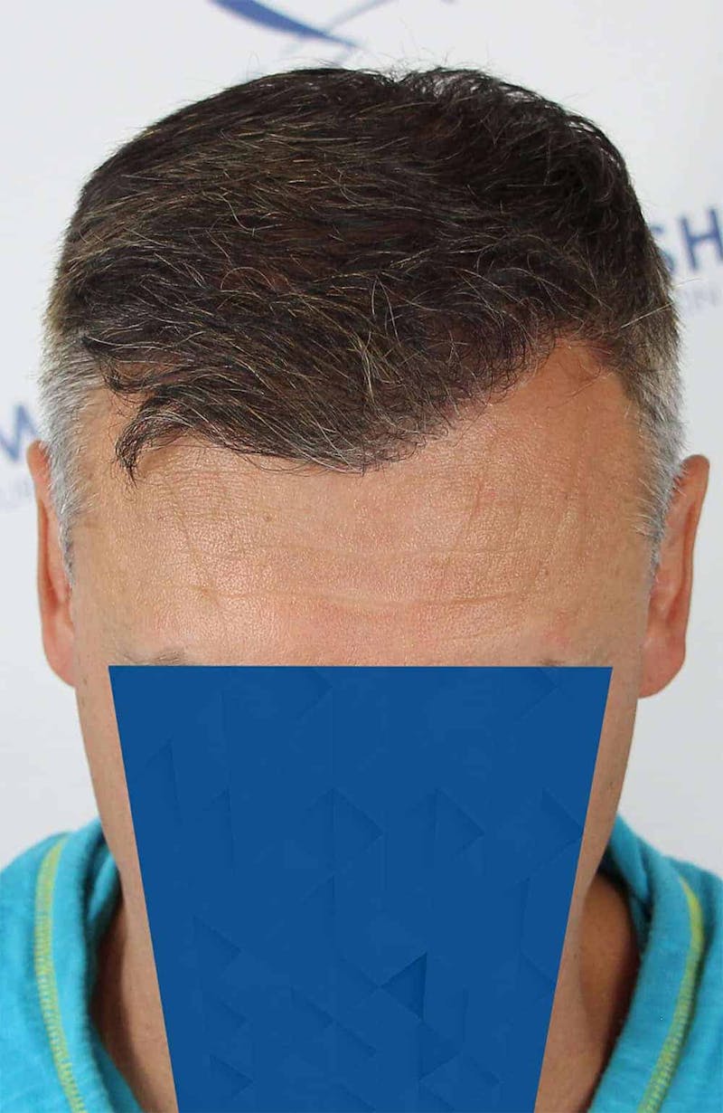 Results Before & After Gallery - Patient 366847 - Image 8